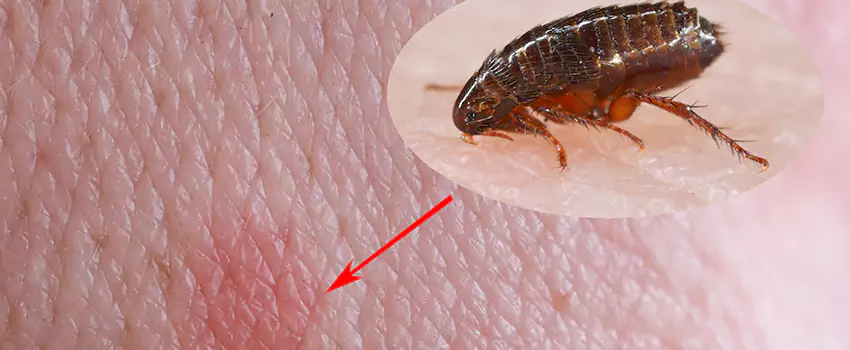 Flea Control for Humans Costa Mesa, CA